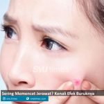 memencet jerawat
