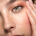 freckles