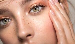 freckles