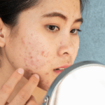 Tips Atasi Masalah Jerawat di Kulit Wajah bagi Remaja Menurut Ahli Dermatologi