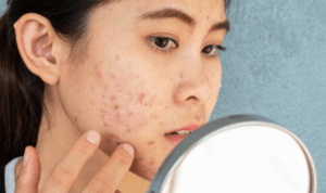 Tips Atasi Masalah Jerawat di Kulit Wajah bagi Remaja Menurut Ahli Dermatologi