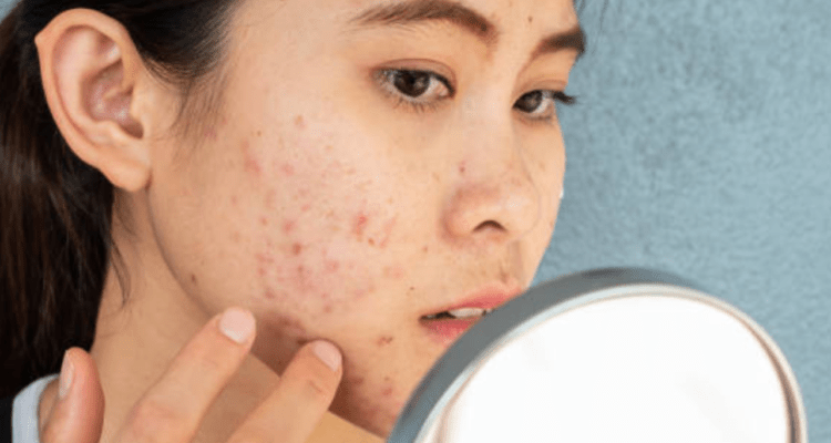 Ilustrasi wajah jerawat Tips Atasi Masalah Jerawat di Kulit Wajah bagi Remaja Menurut Ahli Dermatologi