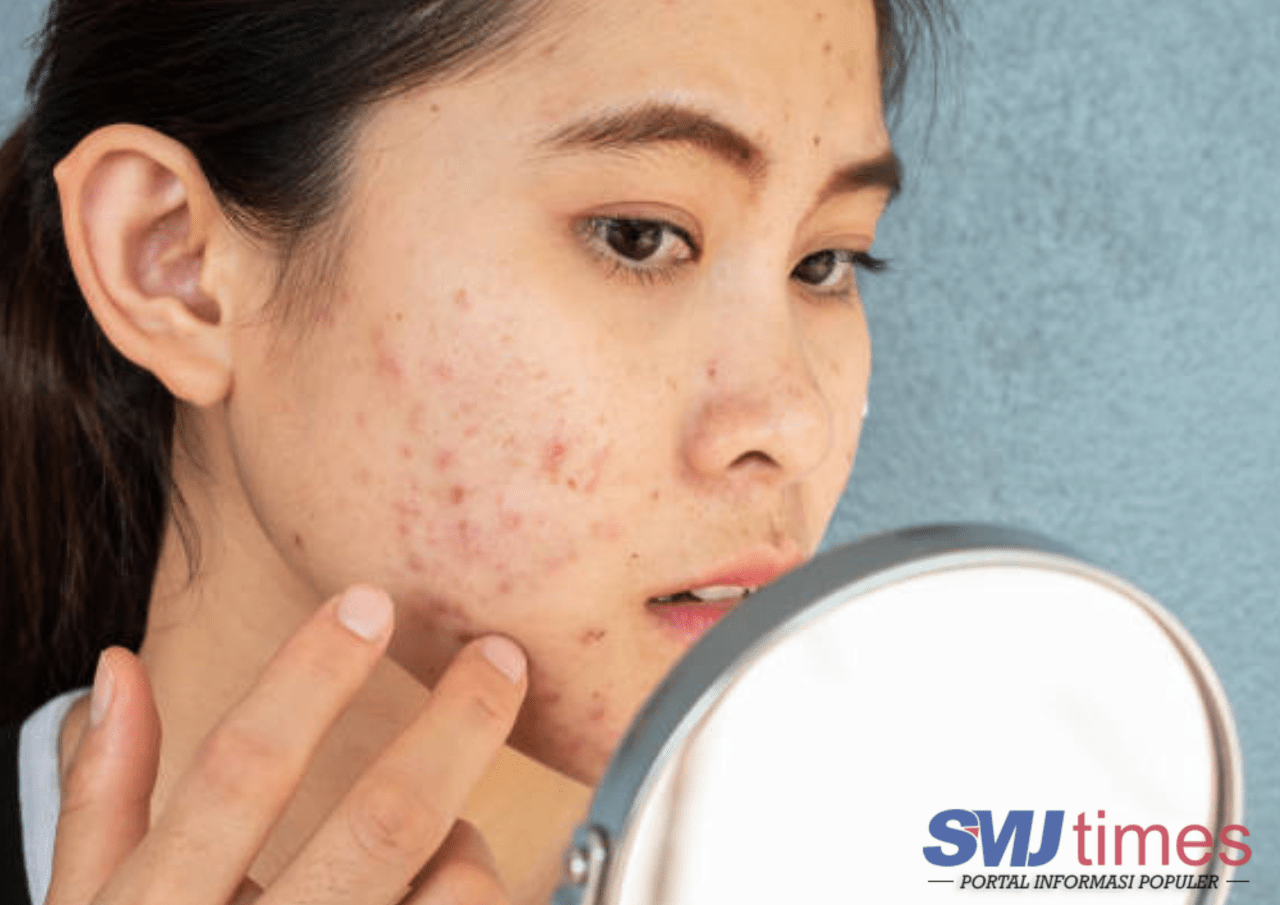 Tips Atasi Masalah Jerawat di Kulit Wajah bagi Remaja Menurut Ahli Dermatologi